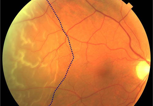 retinal lattice degeneration